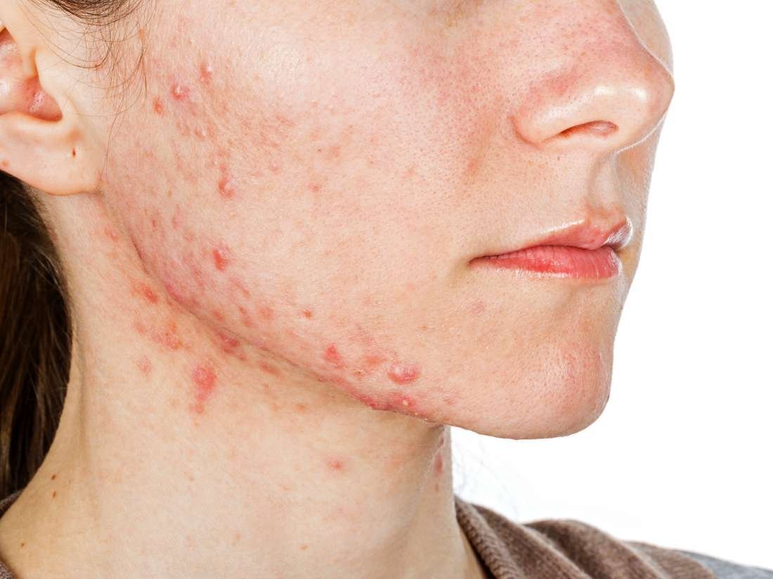 Five Signs You Have Hormonal Acne And How To Avoid It