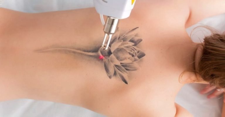 Boosting Your Lymphatic System for Better Tattoo Removal Results